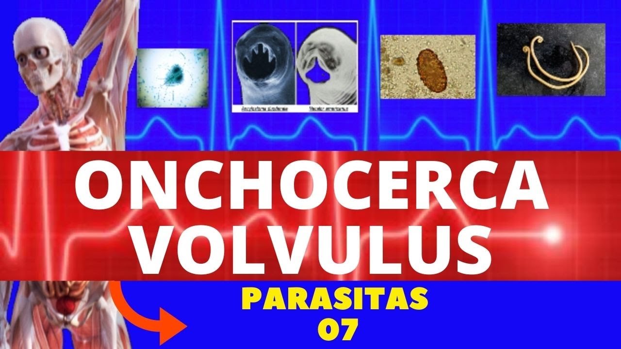ONCOCERCOSE - ONCHOCERCA VOLVULUS (VERMINOSE) - PARASITOLOGIA | INFECTOLOGIA