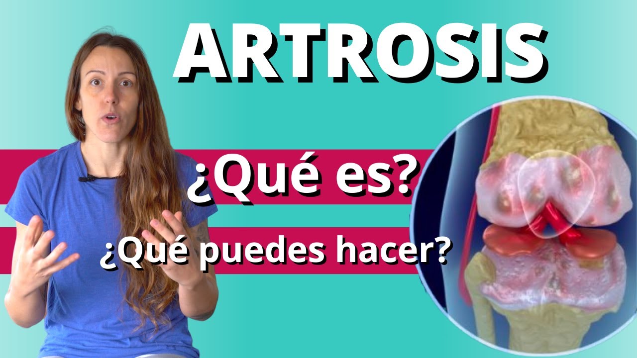 Artrosis: Explicación Sencilla, Falsos MITOS y Recomendaciones de Tratamiento