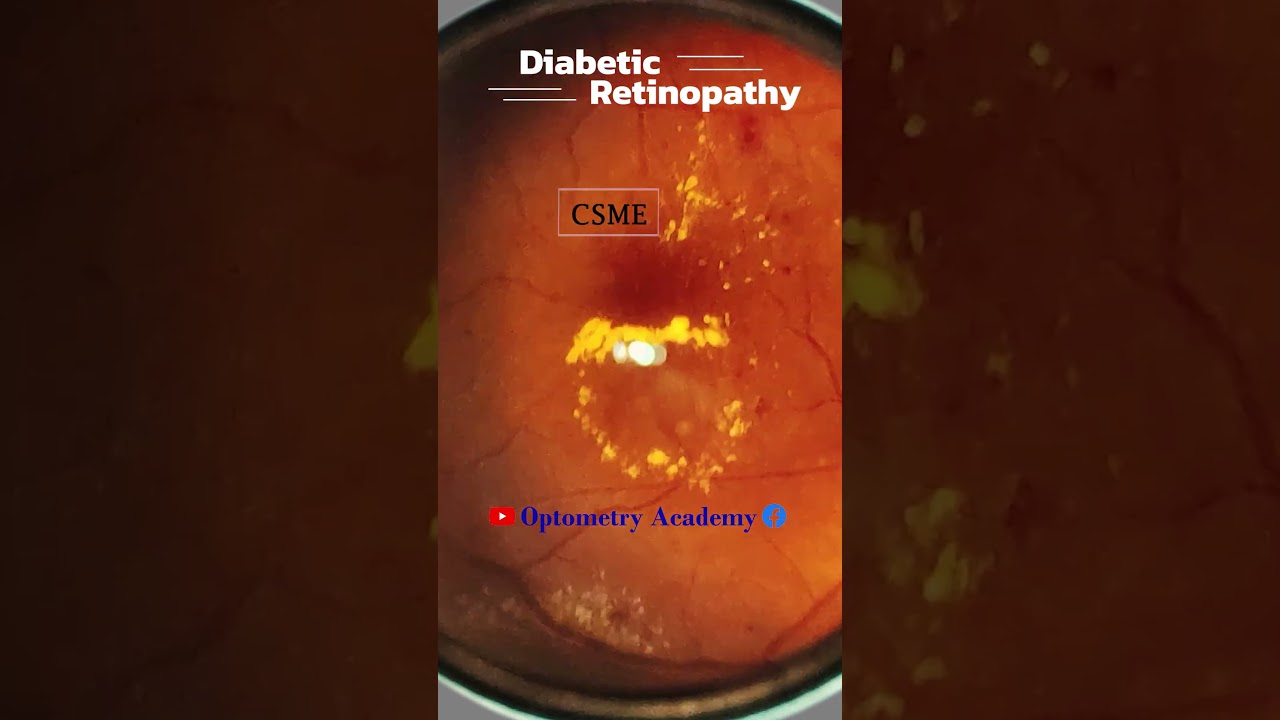 CSME | Hard Exudates | Diabetic retinopathy | Fundus Photography | Short Video 415