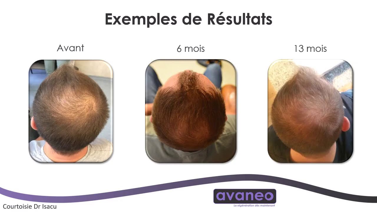 [Rigenera&reg;] La m&eacute;sogreffe Rigenera - fonctionnement et cas patients