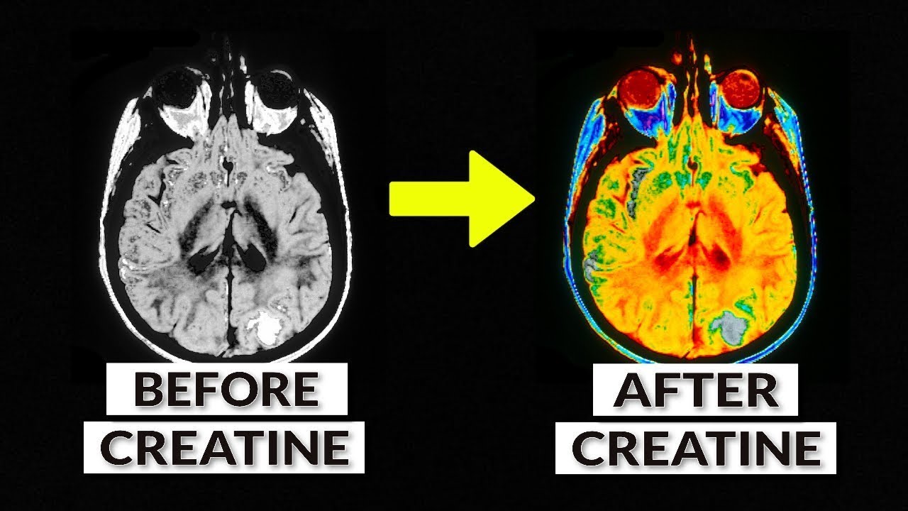 How Creatine Cures Depression | Brain Chemistry Explained