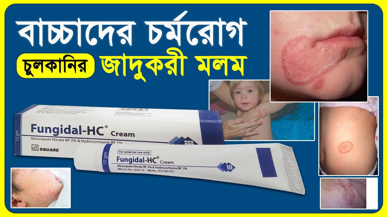 এক মলমে বাচ্চাদের চর্মরোগ হতে মুক্তি! 🌼 Using Fungidal HC Cream for Children's Skin Conditions 🌼