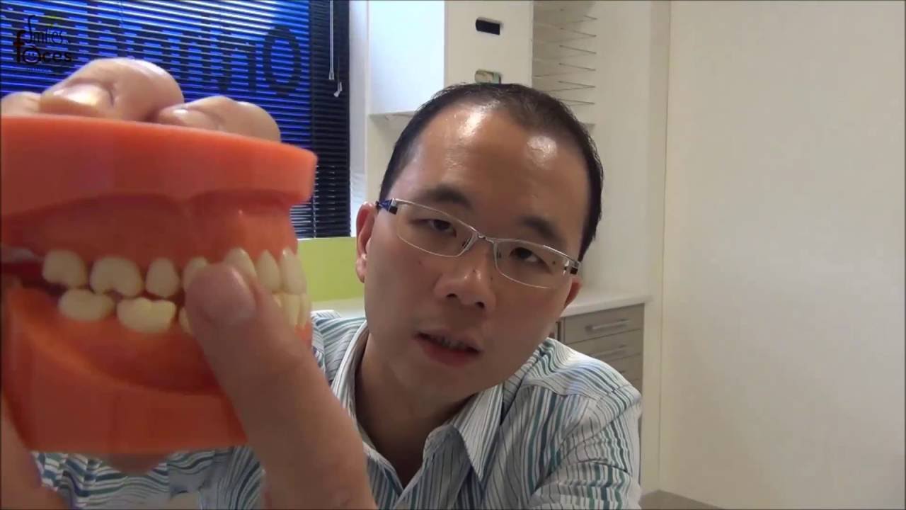 Importance of Early Orthodontic Treatment: 'Underbites'