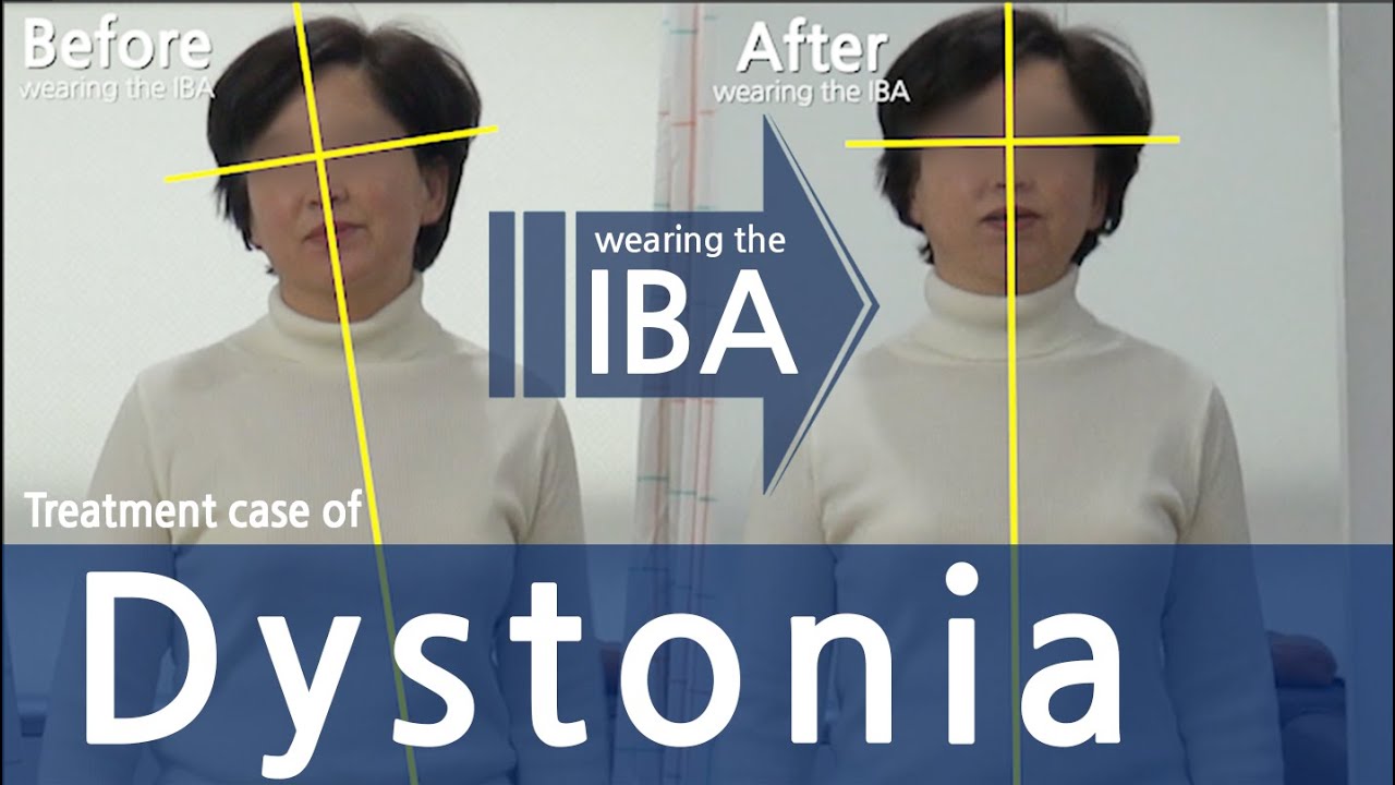 Dystonia / Cervical Dystonia / Spasmodic Torticollis / 사경증 치료 / 근긴장이상증