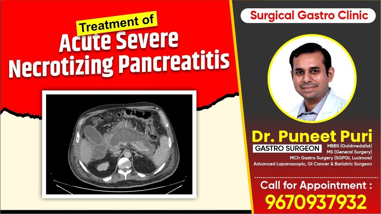 Treatment of Acute Severe Necrotizing Pancreatitis | Dr Puneet Puri | 9670937932 |#acutepancreatitis