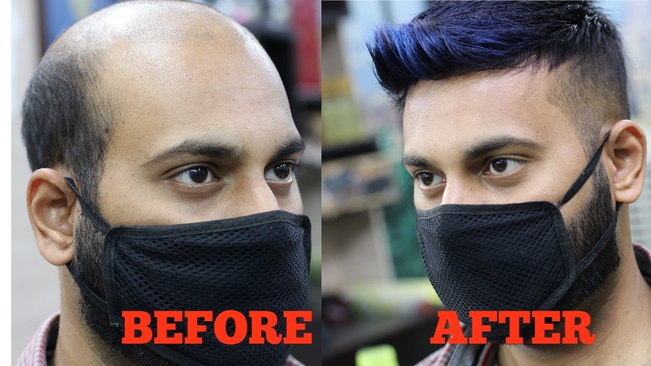 A non surgical hair fixing , hair wig, patchig center in india, RIZY 9582581323