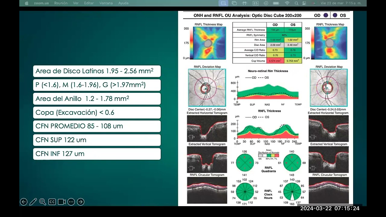 OCT nervio optico en glaucoma. Dr Daniel Gonzalez.  2024_03_22