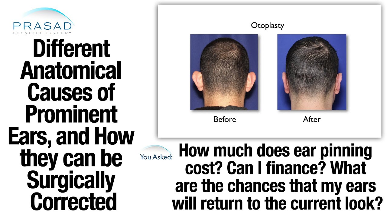 The Different Causes of Prominent Ears and the Different Options of Ear Pinning Surgery