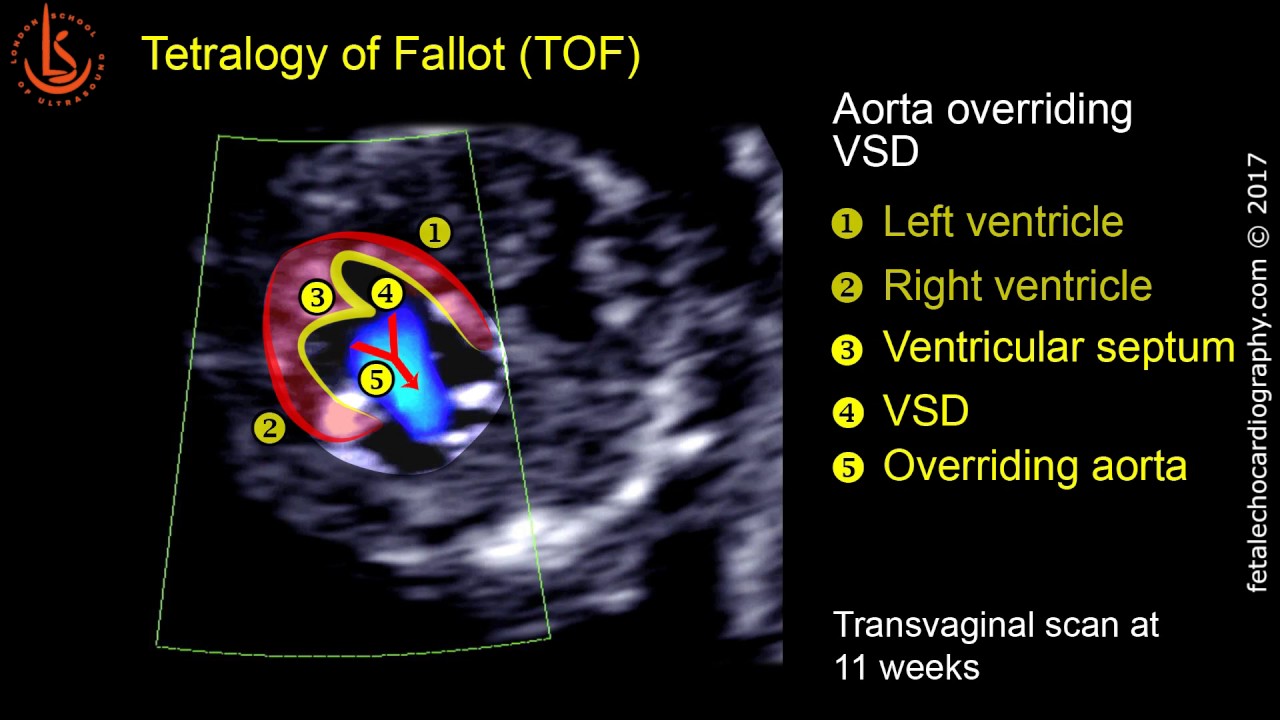 Fetal echocardiography at 11-13 weeks: Tetralogy of Fallot (TOF)