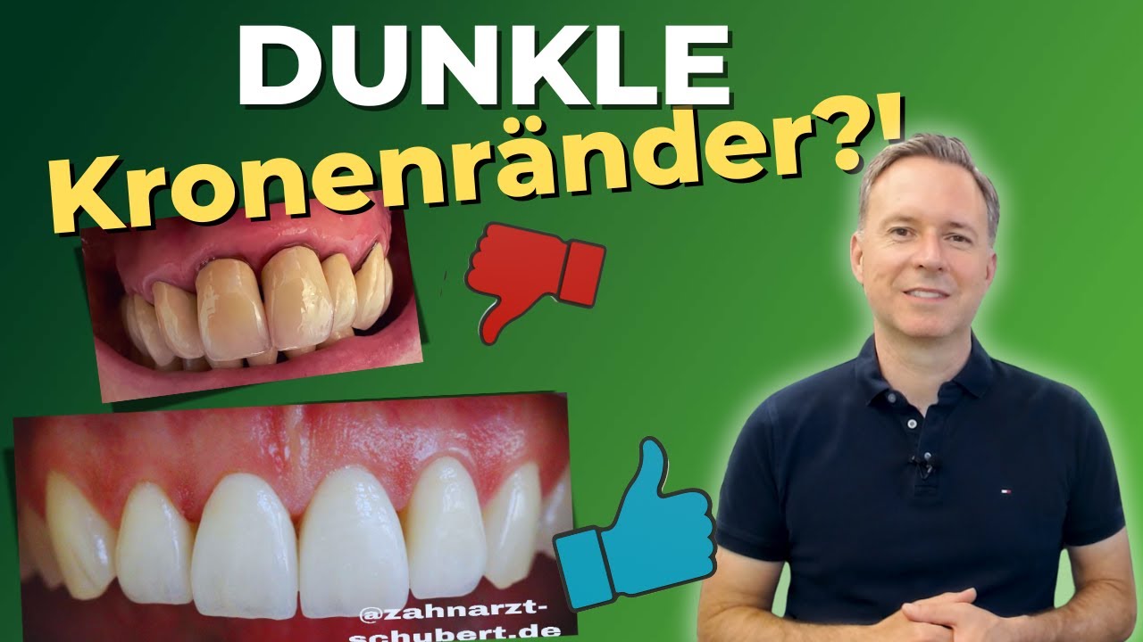 Die Lösung für Dunkle Kronenränder!