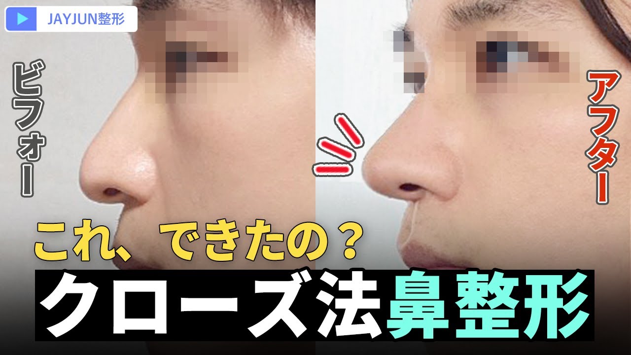【鼻整形】傷跡を残さないクローズ法鼻整形｜向いている人・向いていない人 ✨