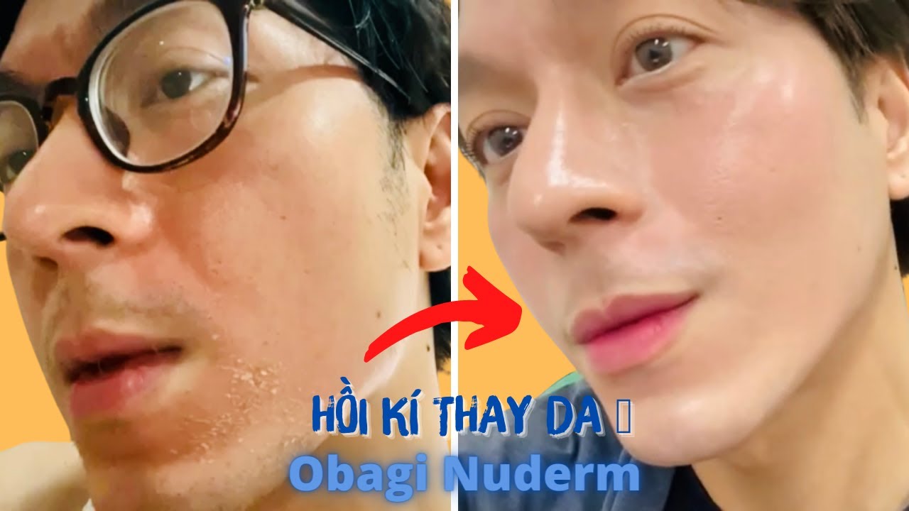 Obagi Nu Derm - Những tháng ngày “thay da” gian nan | Kỳ Kỳ
