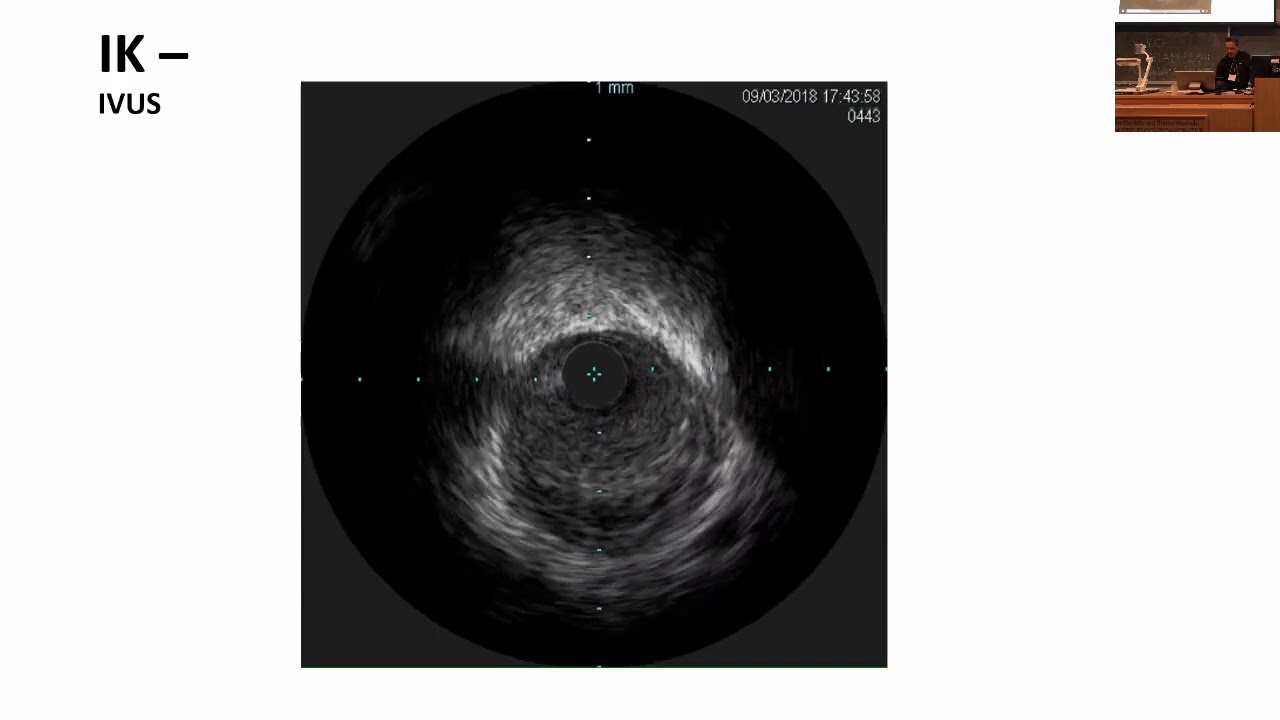 Fung IntracoronaryImag VanSCAD2019
