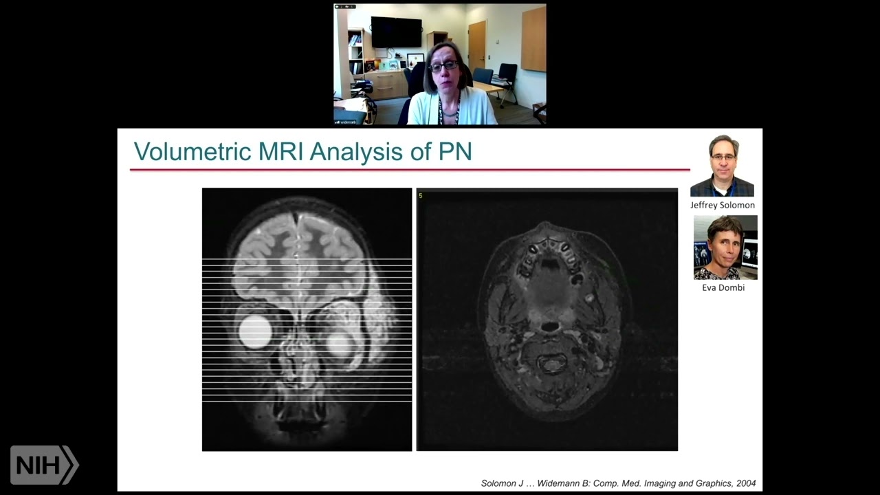Advancing Therapies for Neurofibromatosis Type 1 (NF1): Lessons Learned from Every Patient