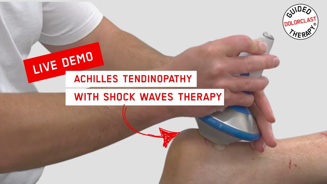 How to treat Achilles Tendinopathy with DolorClast® Shock Waves - Live Treatment by James Ferrie