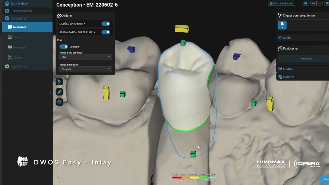 DWOS by Dental Wings - EASY - Inlay
