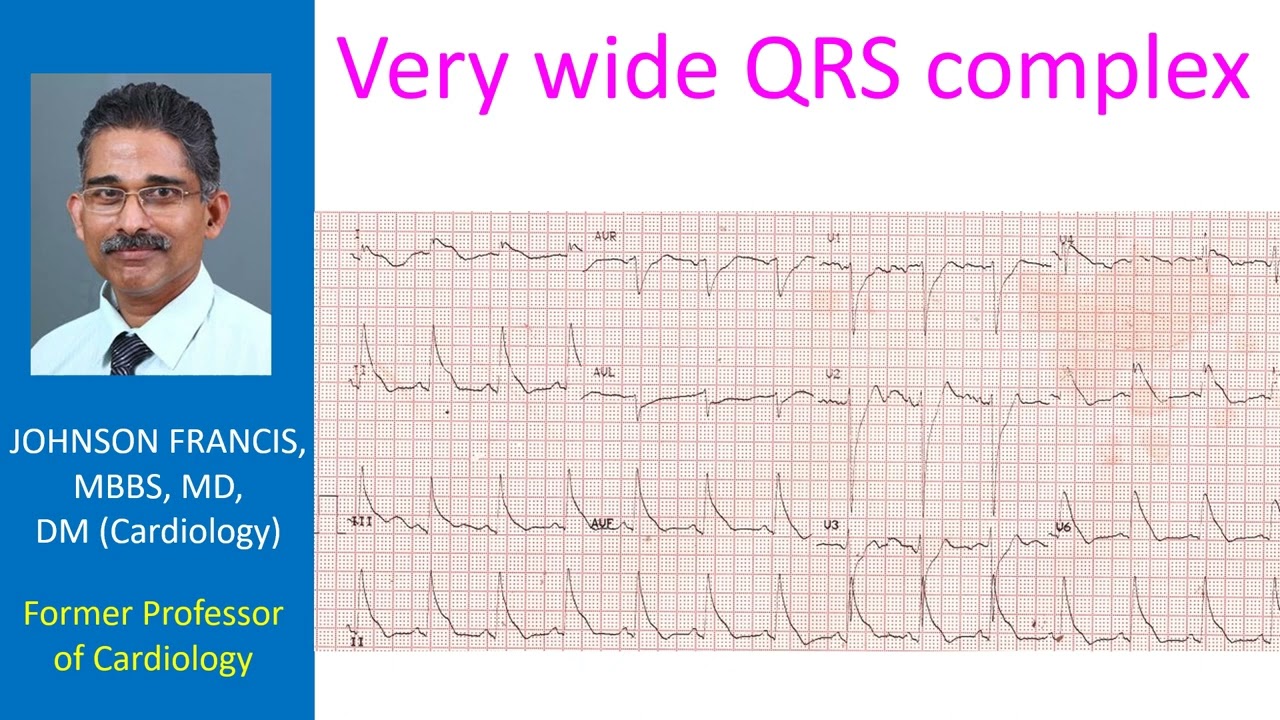 Very wide QRS complex