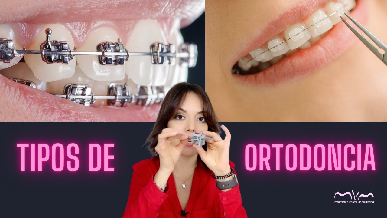 CONOCES LOS TIPOS DE BRACKETS? CUAL ES MI FAVORITO 👌