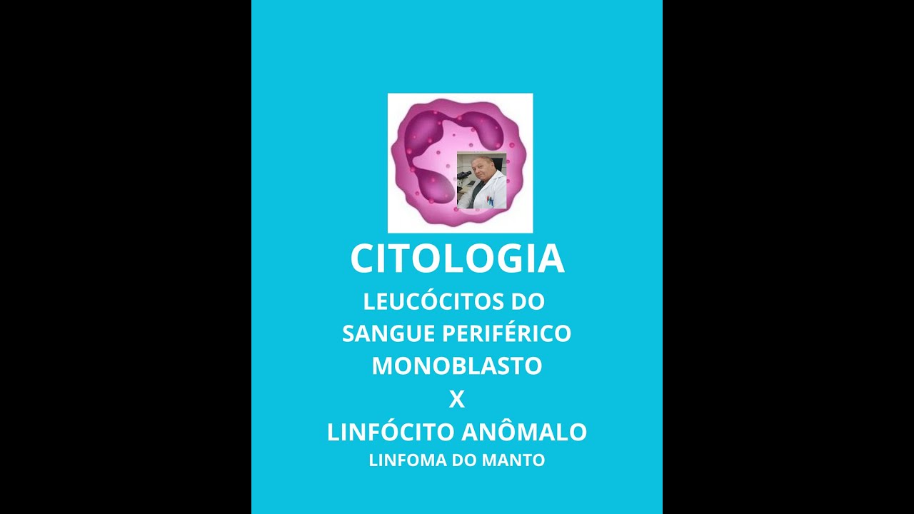 DESCOMPLICANDO MONOBLASTO DE LINFÓCITOS ANÔMALOS