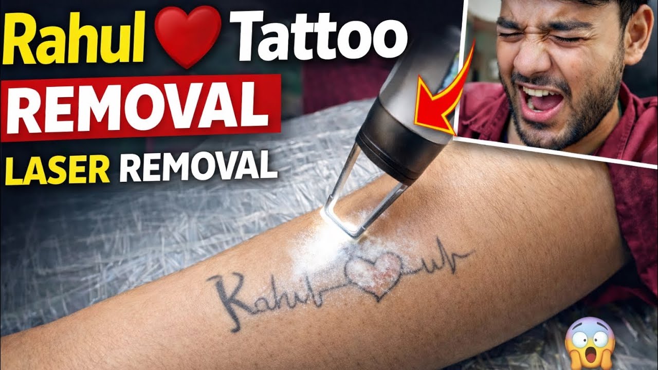 Rahul ❤️ Tattoo Removal | PicoSure Laser First Session Result 😱 SADARBAZAR AGRA 