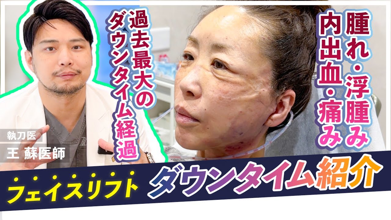 【ダウンタイム紹介】執刀医と一緒に見るダウンタイムの経過！ フェイスリフト/脂肪移植【王 蘇 / 佐藤くん】#zetithbeautyclinic #若返り #王蘇