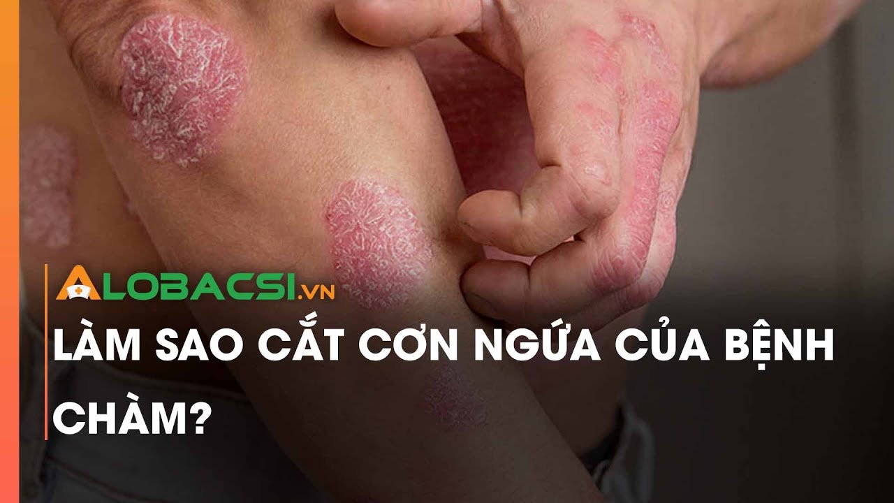 L&agrave;m sao cắt cơn ngứa của bệnh ch&agrave;m?