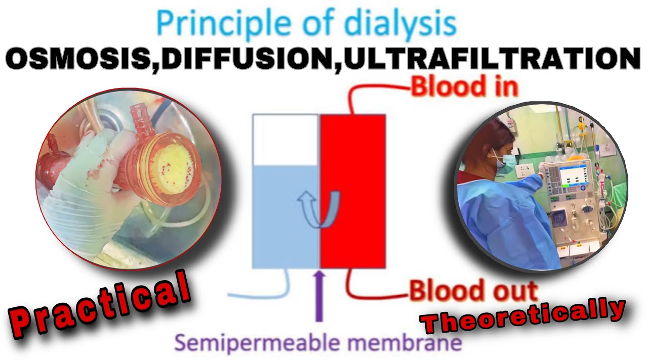 Principle of Hemodialysis | How Dialysis Works