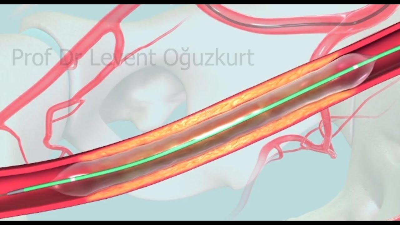 Anjiyo yöntemiyle balon ve stent kullanarak tıkalı damarı açmak