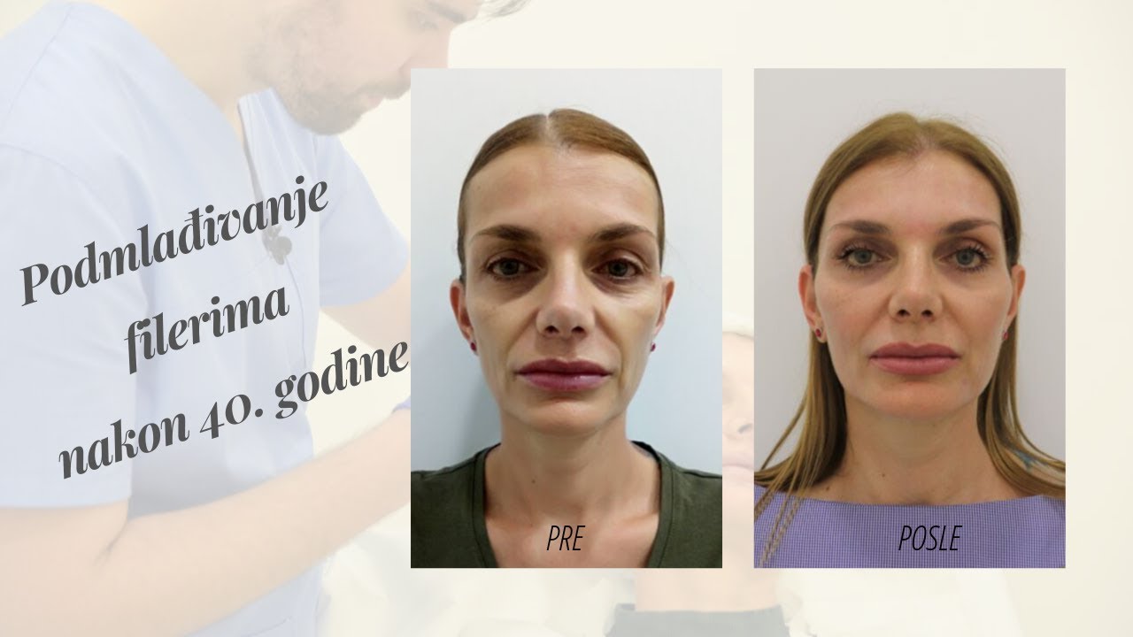 Hijaluronski fileri l Podmlađivanje nakon 40.godine : rezultat dugoročnog plana tretmana