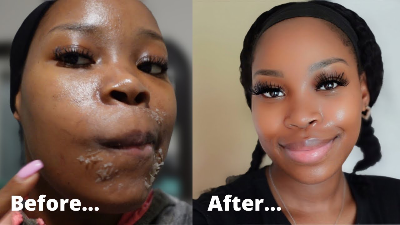 Chemical Peel Full Process| Hyperpigmentation skin| Black Girl Edition