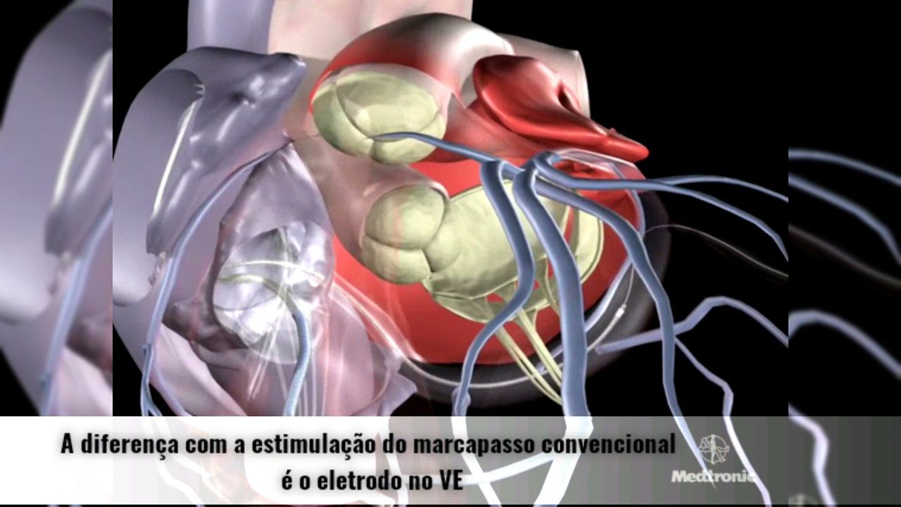 Entenda como funciona o CDI (cardiodesfibrilador implantavel) e Ressincronizador em menos de 3 min.