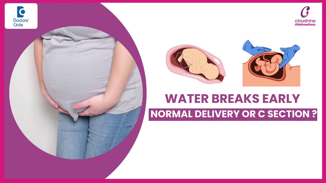 WATER BREAKS EARLY- Best Treatment-Dr.Nandyala R Padmapriya at Cloudnine Hospitals |Doctors' Circle