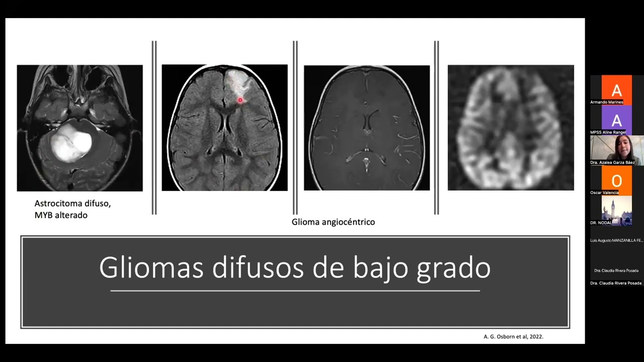 Tumores cerebrales en pacientes pediátricos