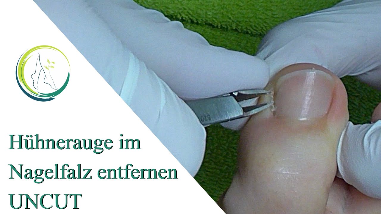 Hühnerauge im Nagelfalz entfernen Uncut