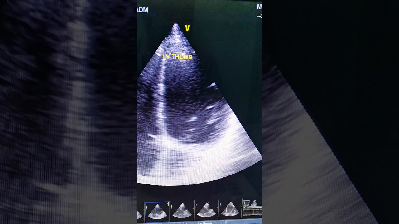 ارتفاع كبير في كفاءة عضلة القلب من 20٪الي 42٪..  01114224160