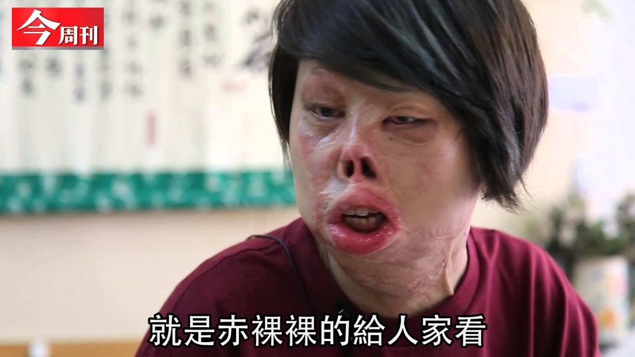 《今周刊》火燒截3肢  鋼鐵女孩：我赤裸裸的給人家看