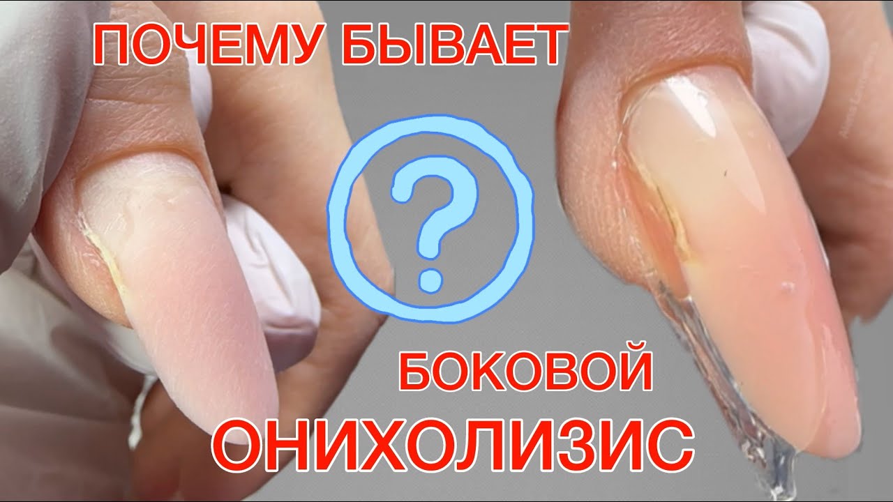 БОКОВОЙ ОНИХОЛИЗИС | КОРРЕКЦИЯ ГЕЛЕМ | ВЕРХНИЕ ФОРМЫ #алена_лаврентьева #nails #ногти #маникюр