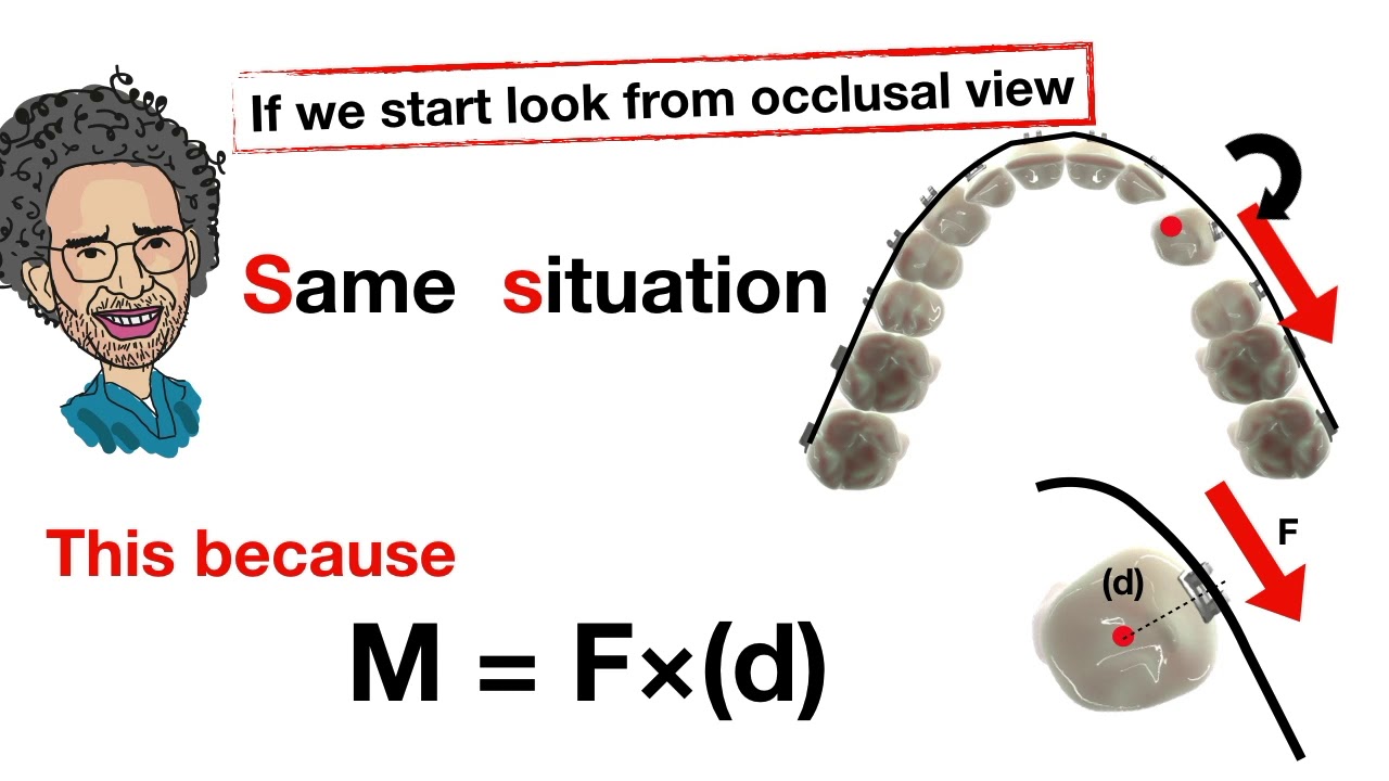 2nd canine orthodontic tip