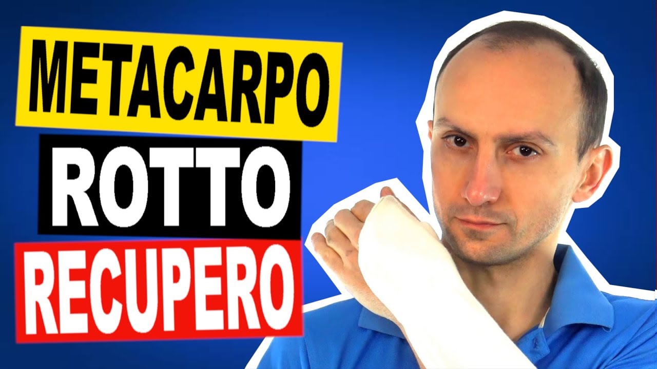 Frattura del Metacarpo: Esercizi di Riabilitazione e Come Guarire Presto