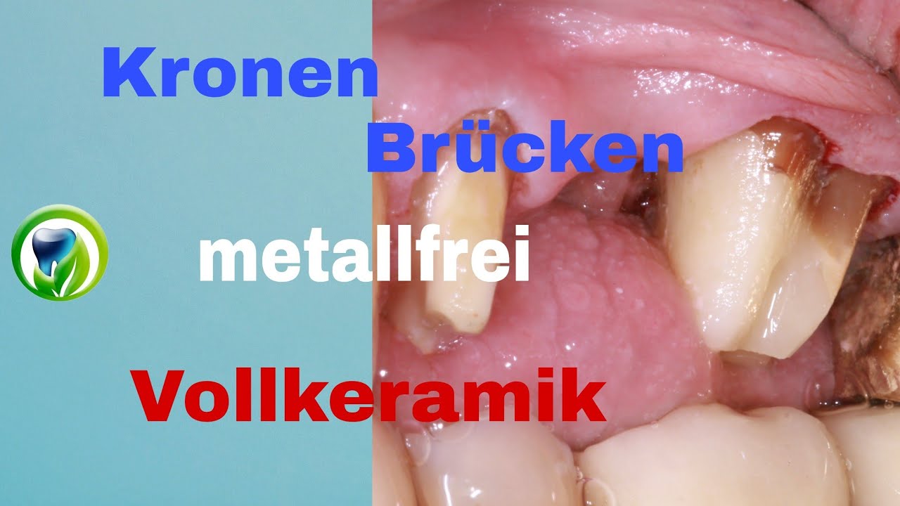 Patientenfall Kronen und Br&uuml;cken metallfrei/  aus Vollkeramik, Zirkon, Glaskeramik, Lithiumdisilikat