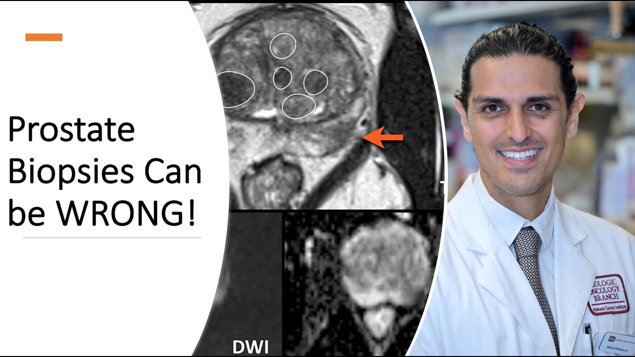 Prostate Biopsies Can Be WRONG! -  Dr. Ahdoot Explains Prostate Cancer Diagnosis