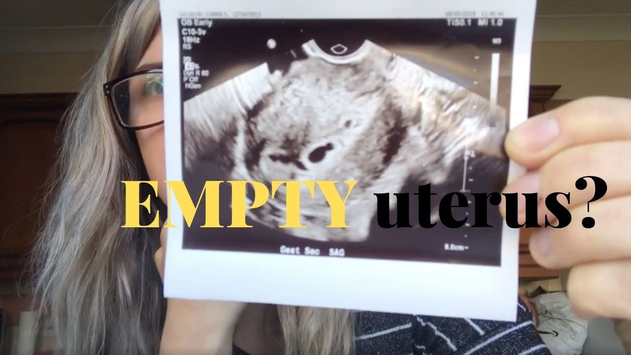 OHSS update and EMPTY uterus
