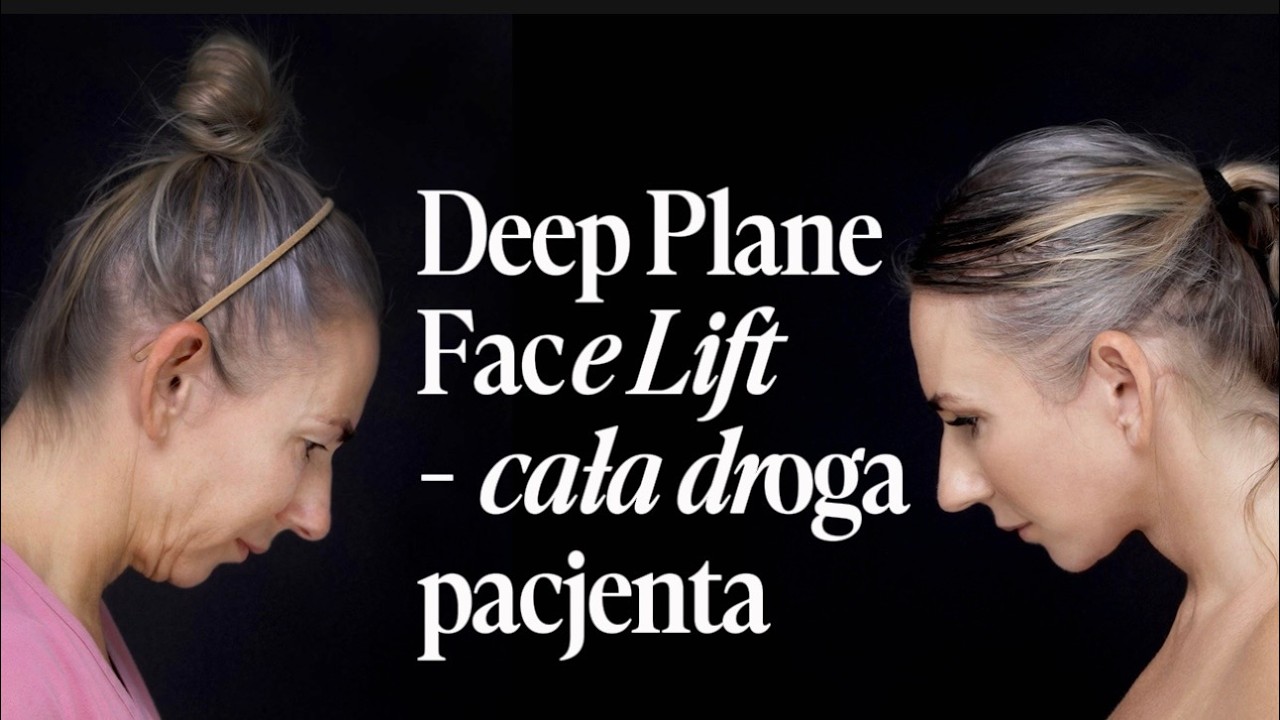 Deep Plane Face Lift - cała droga pacjenta.