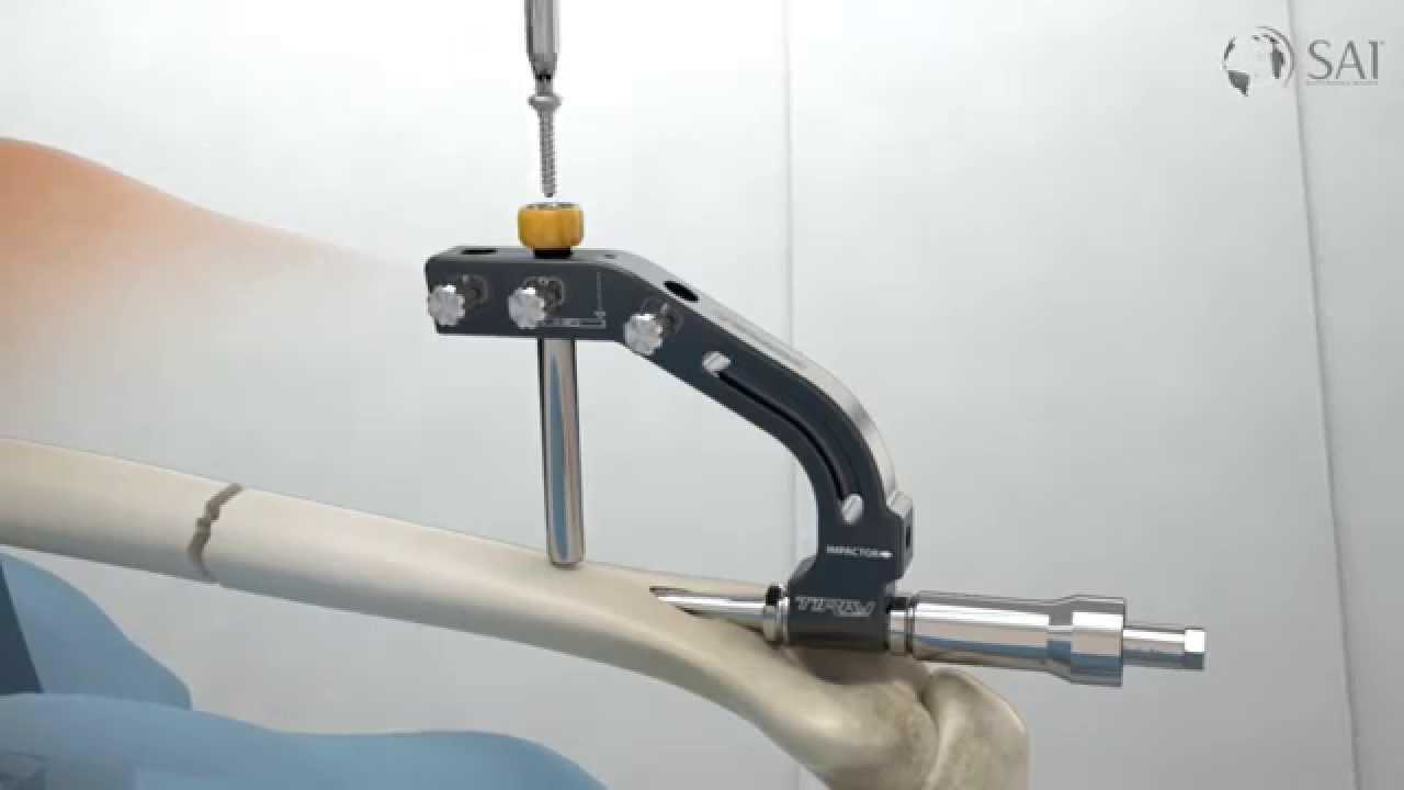 South America Implants S.A. - DC-542-00 Clavo endomedular para húmero TIRAY