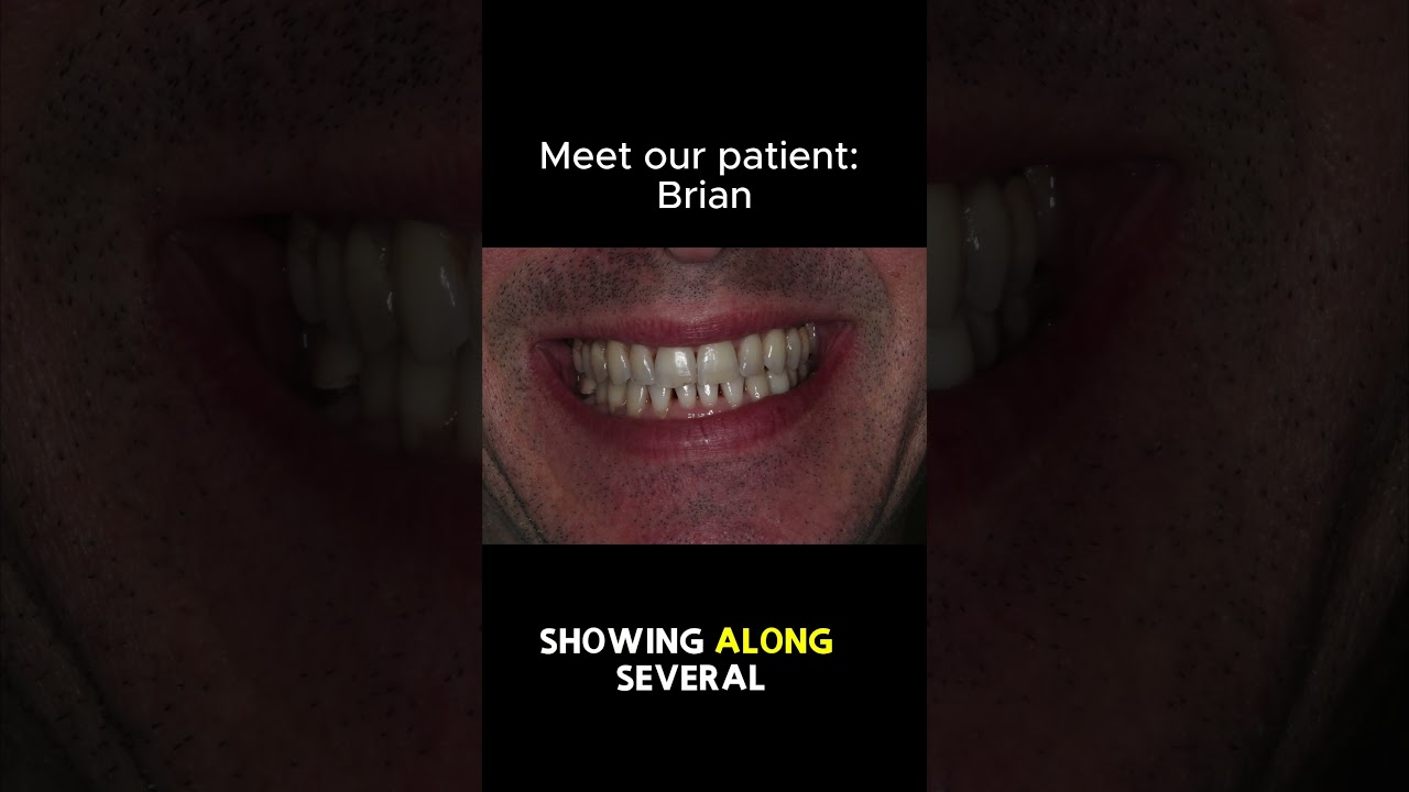 😊Same Day After Pinhole&reg;! Get back Your Natural Smile #gumrecession #pinholesurgicaltechnique