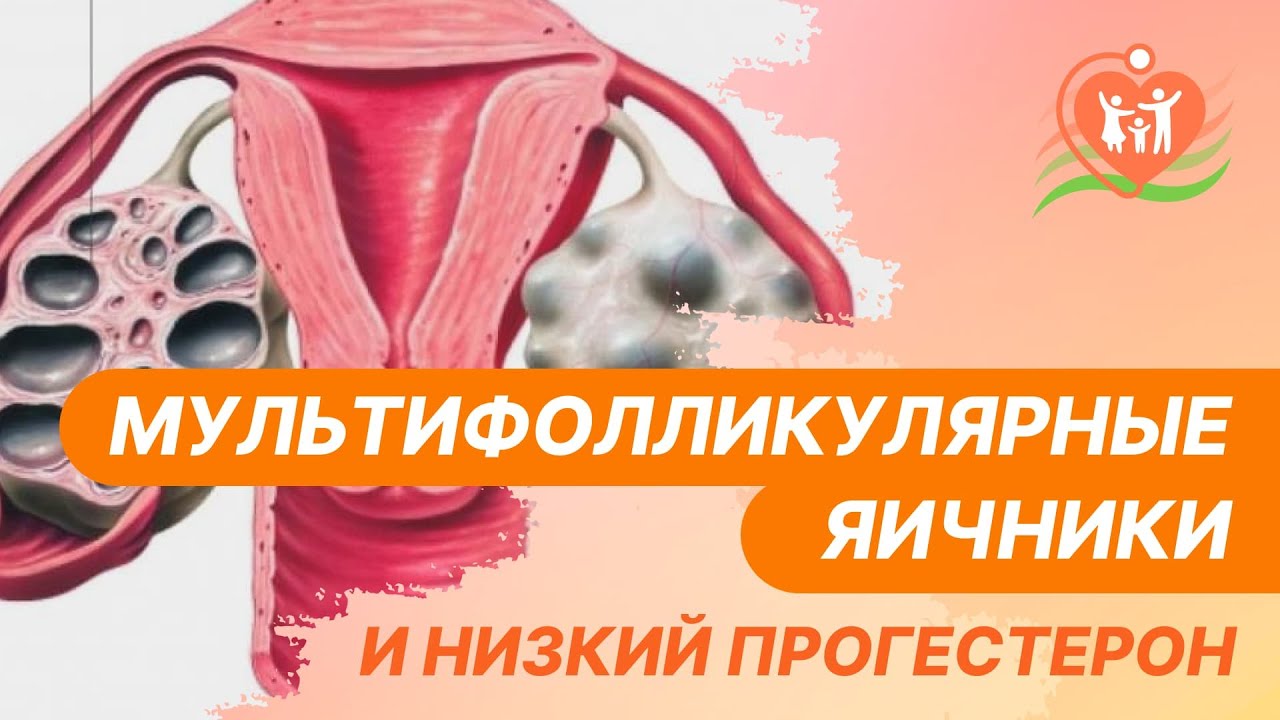 📌 Мультифолликулярные яичники и низкий прогестерон