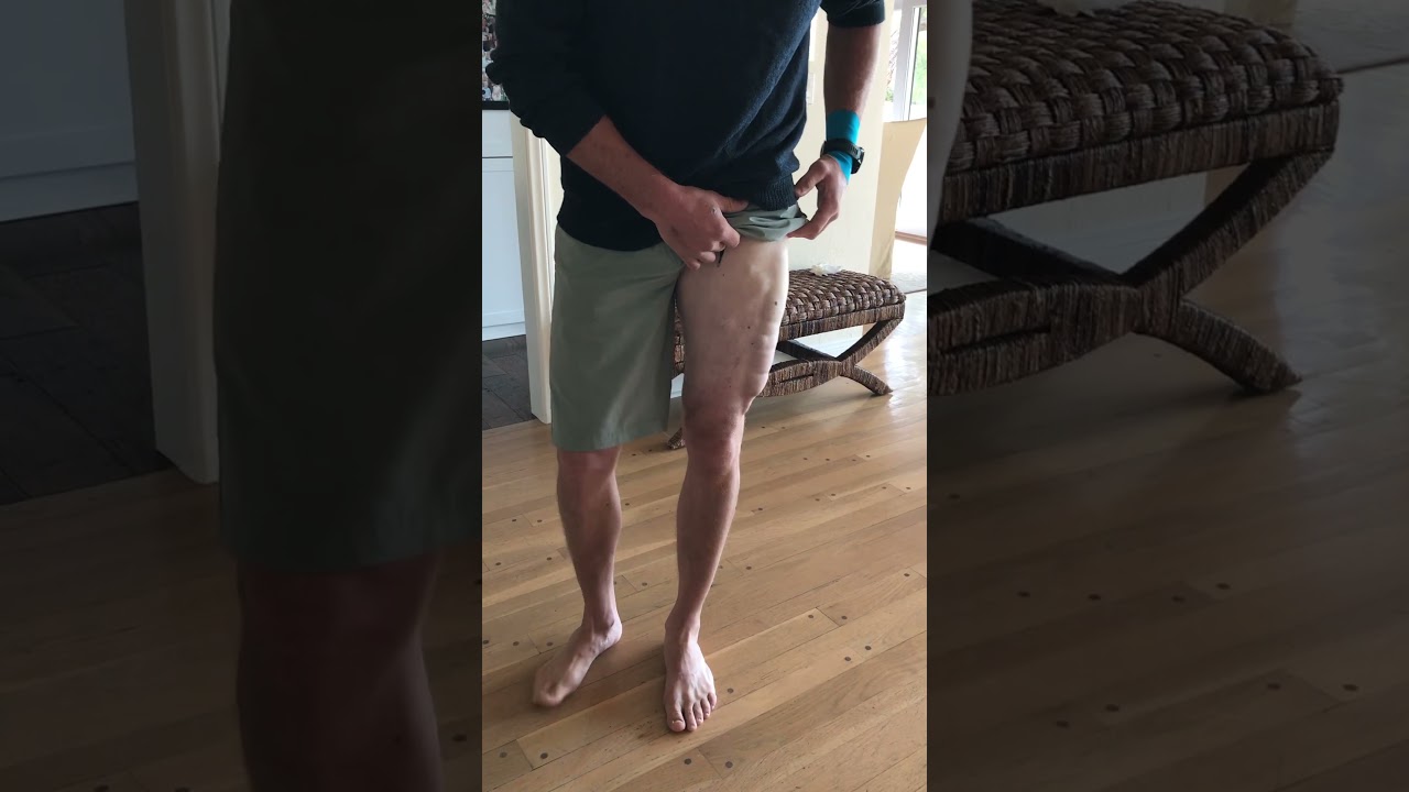 Compartment Syndrome (Post-Fasciotomy) 