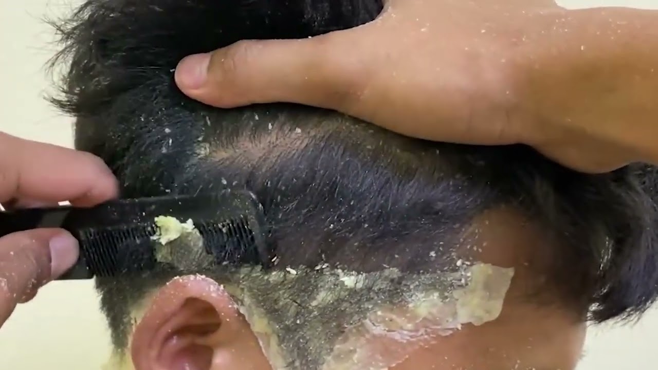 DRY SCALP  !! Big Flakes Dandruff Scratching #109