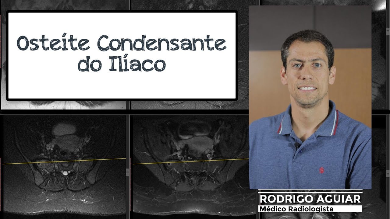 Osteíte Condensante do Ilíaco