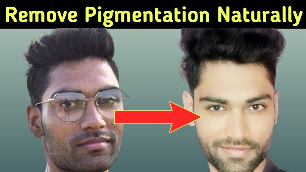 Face Pigmentation Treatment at Home | How to remove Pigmentation from face Naturally